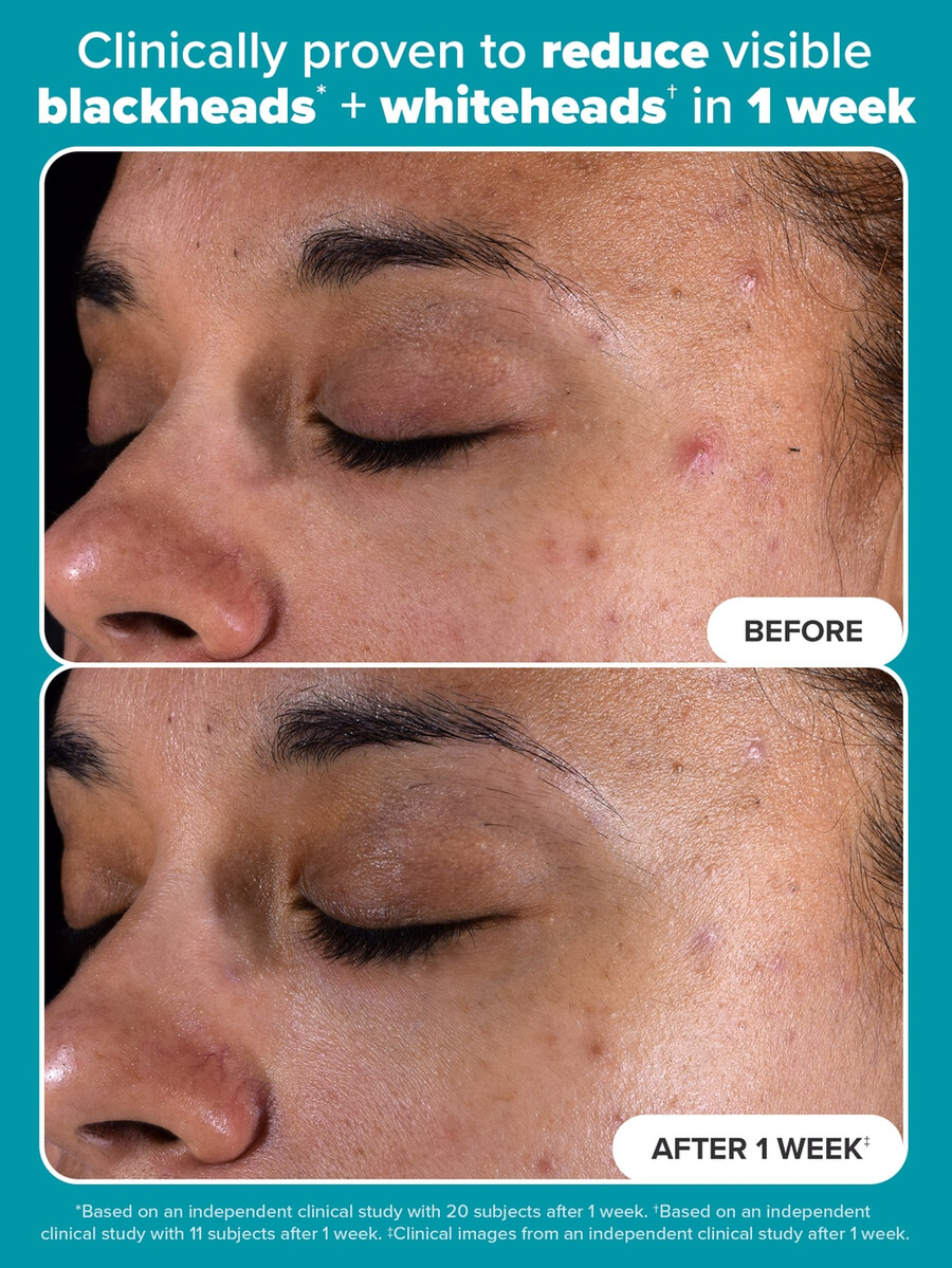 toallitas exfoliantes con 2 bha