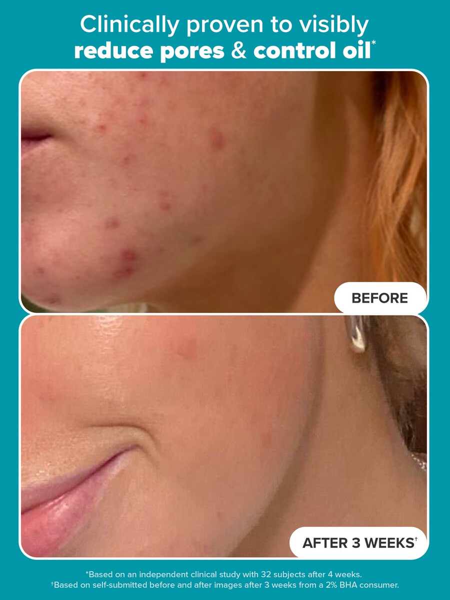 exfoliante líquido skin perfecting 2 bha