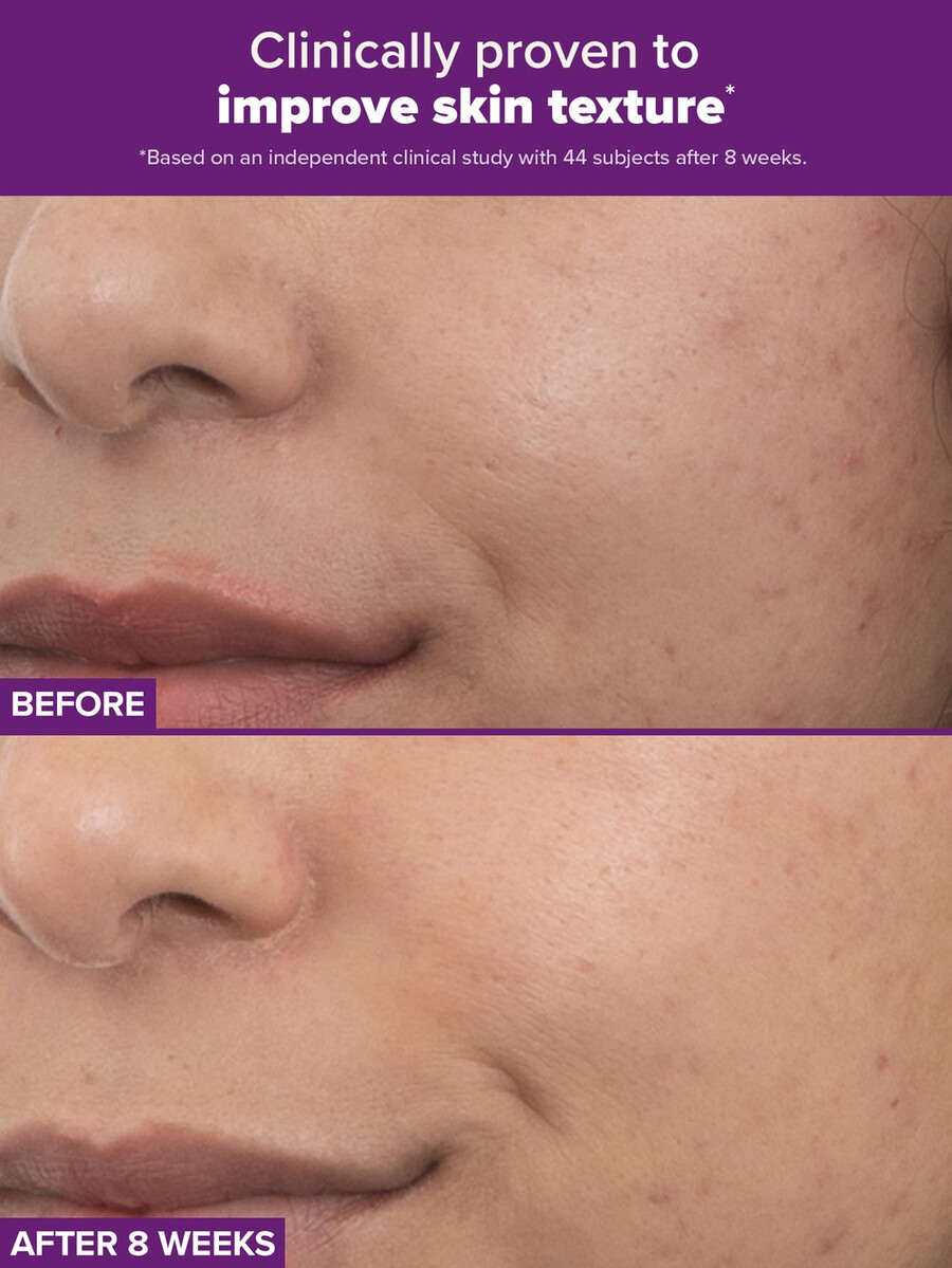 tratamiento dual con retinaldehído y retinoides clinical pro